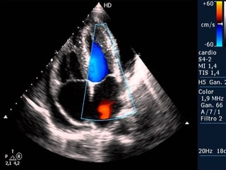 Ecocardiograma Doppler Color - Ecocardiograma Fetal